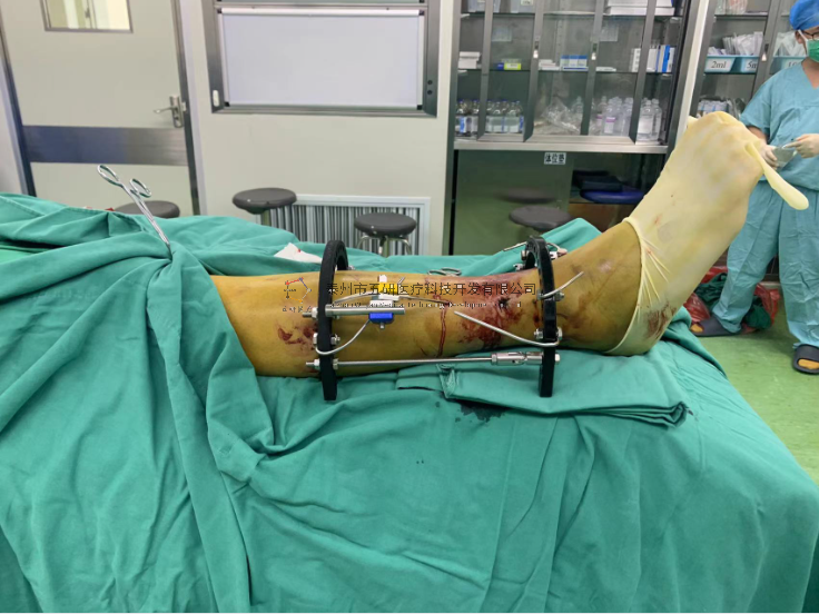 【望京醫(yī)院】不開刀治骨折病例分享——右脛骨遠(yuǎn)端骨折